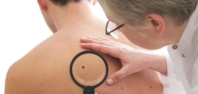 Person being checked for skin cancers.