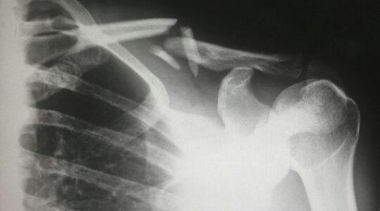 Improved AI X-ray tool to ease demand for radiologists