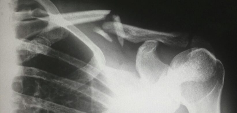 X-ray. | Newsreel